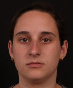 Rhinoplasty
